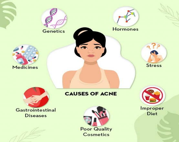 Causes of acne.png