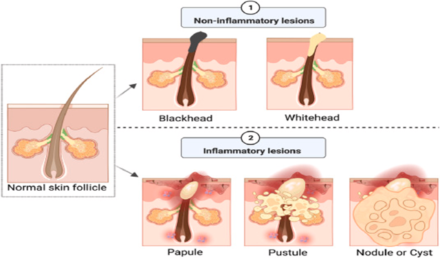 Types of acne.png